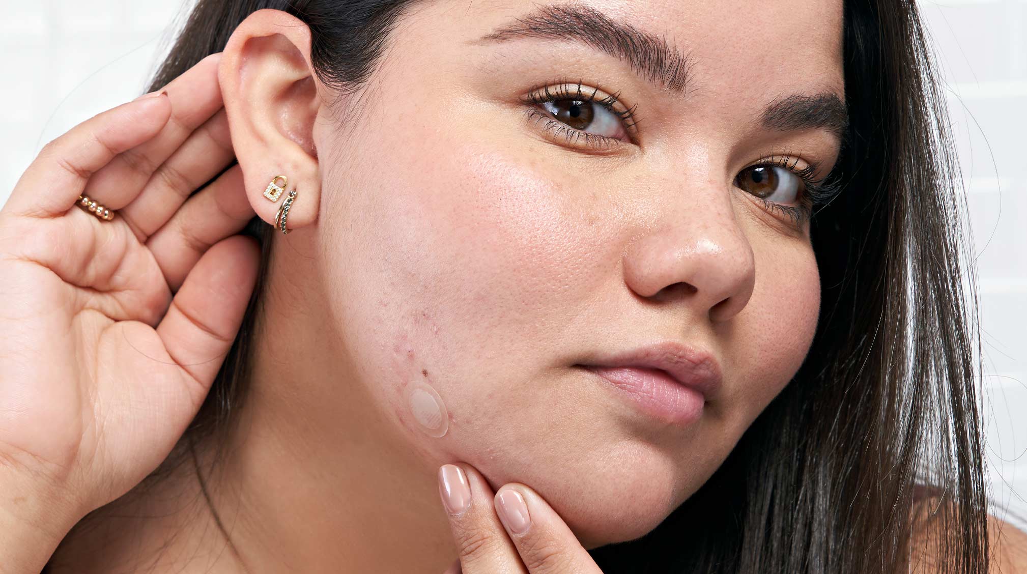 Dealing with Post-inflammatory Erythema: Fade Red Marks after Acne