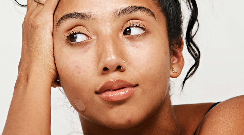 How to Get Rid of a Pimple Overnight