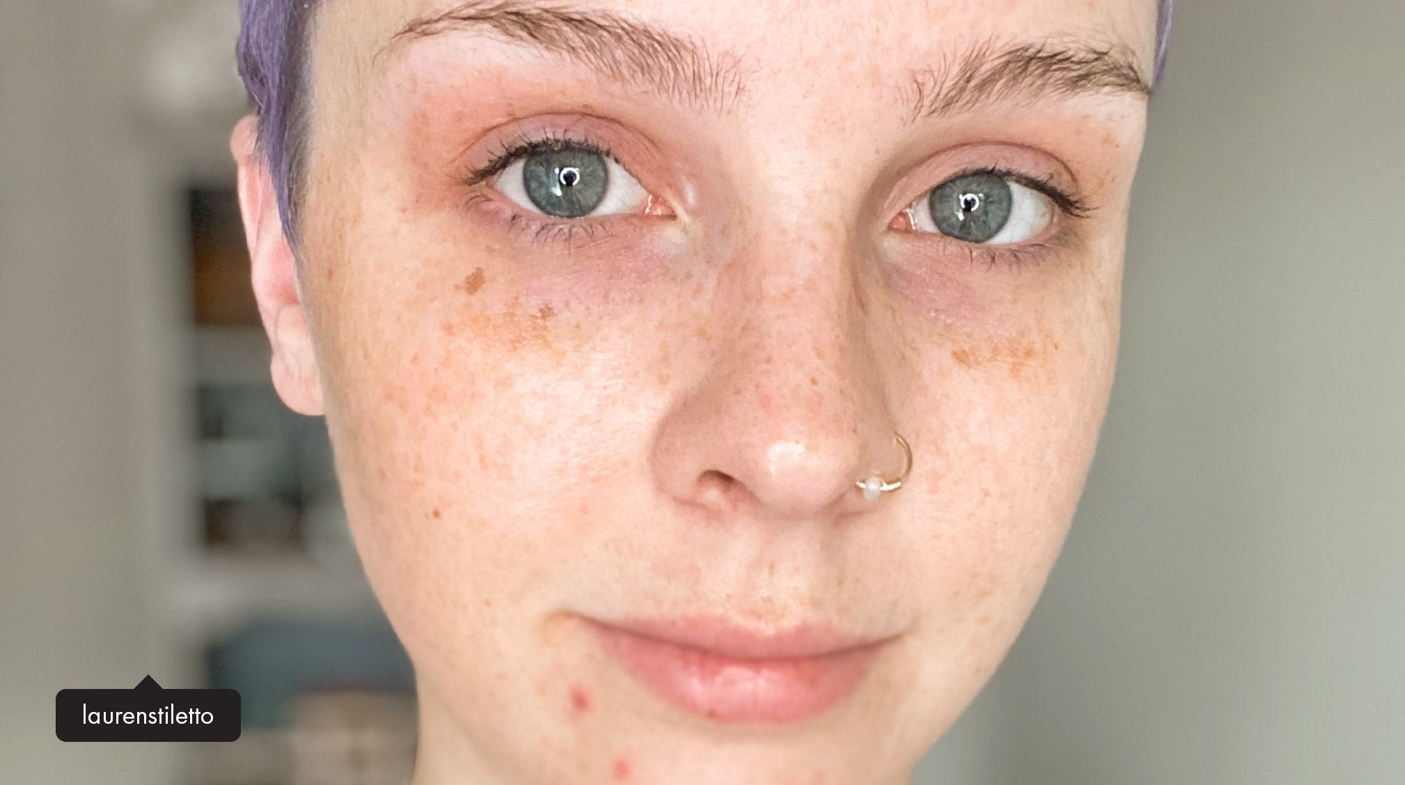 Spots 101: Your Ultimate Guide to Differentiating Pigmentation
