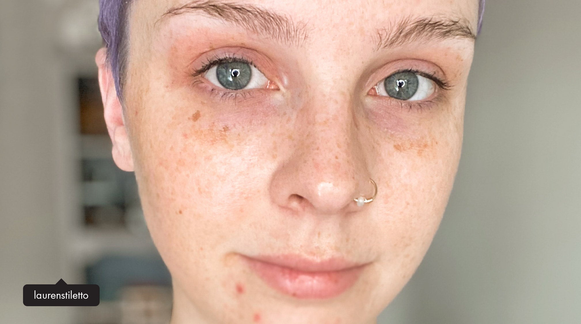Spots 101 Your Ultimate Guide To Differentiating Pigmentation Spots spots-101-your-ultimate-guide-to-differentiating-pigmentation-spots