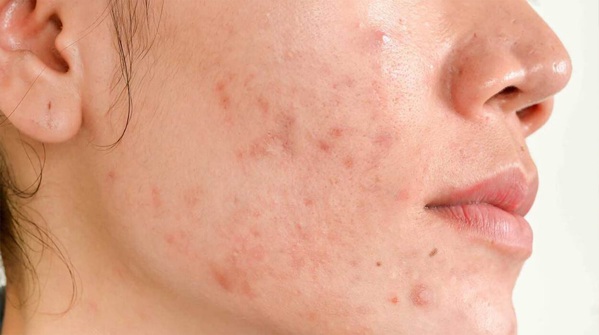 Caucasian woman with hormonal acne on face