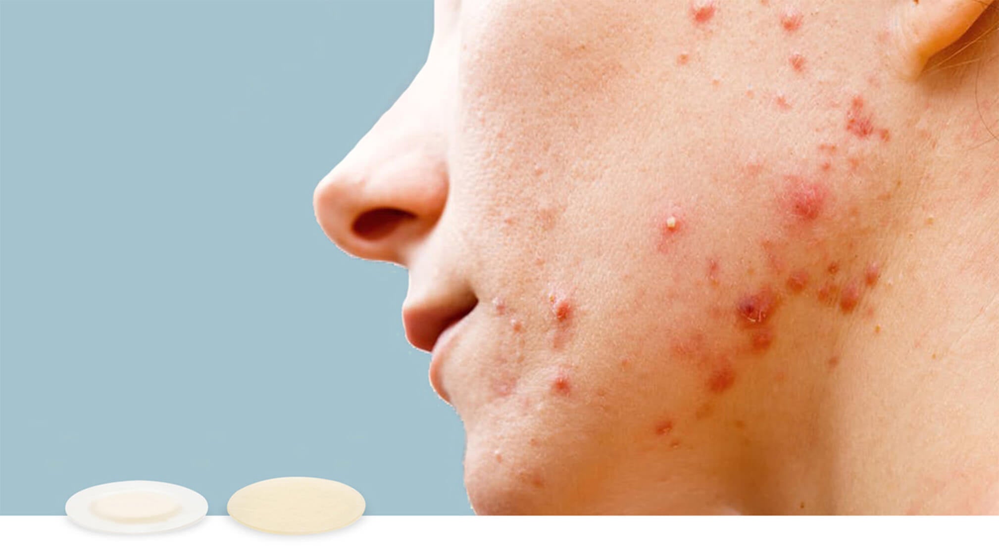 Woman with acne and acne scarring on jaw and cheek