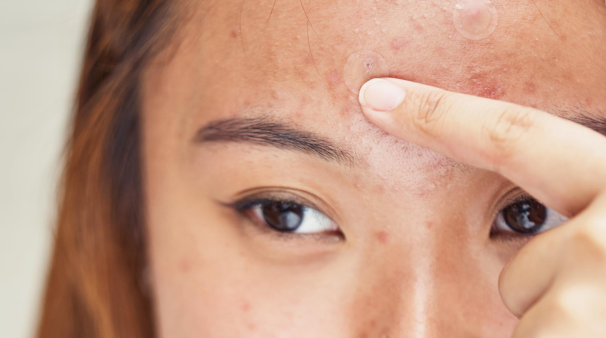 Woman pointing to acne on forehead