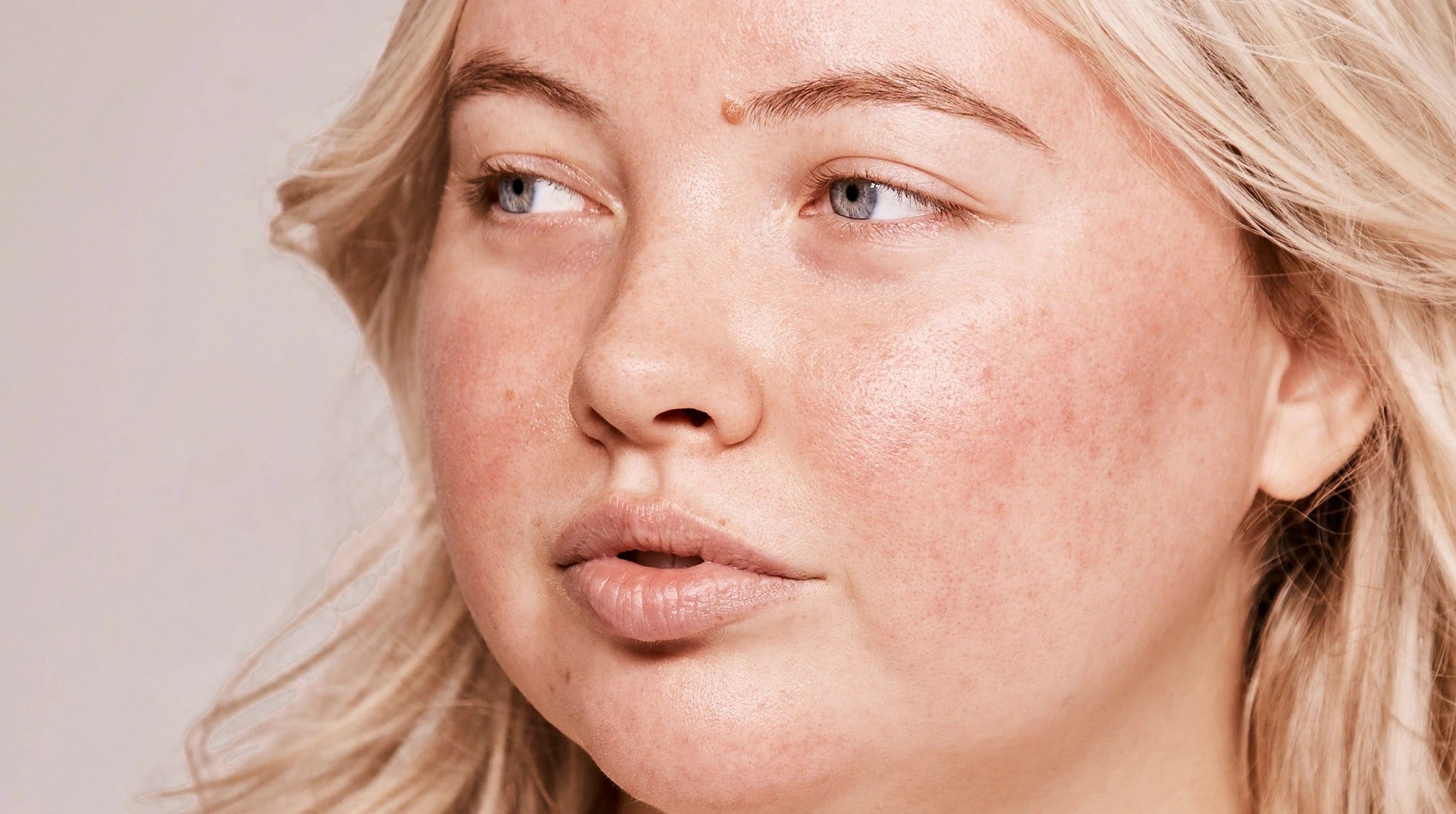 Is It Rosacea or Just Redness? Here Are 3 Derm-Recommended Ways to Tell the Difference.