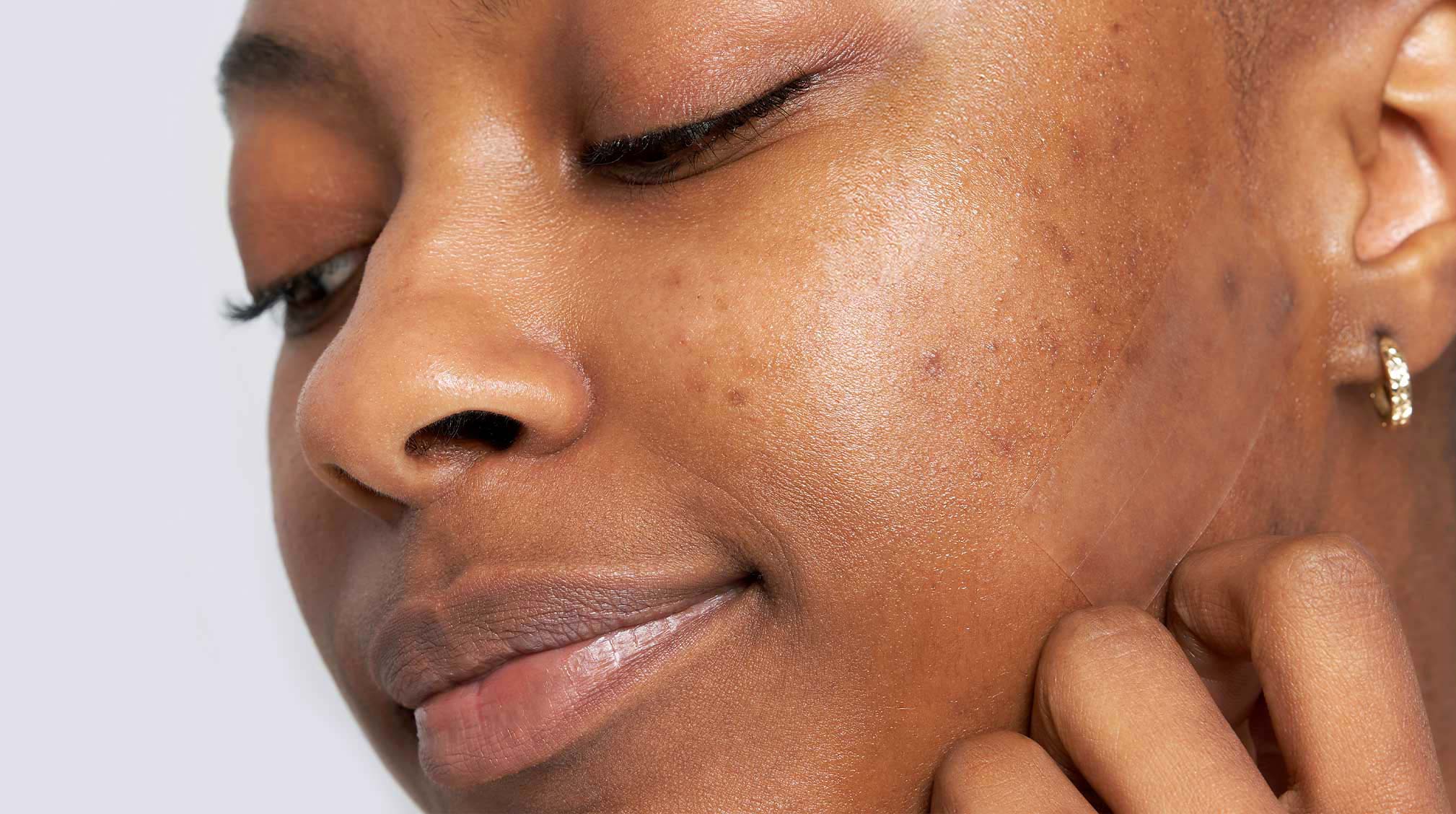 Dark skinned woman showing acne scars and hyperpigmentation on cheek
