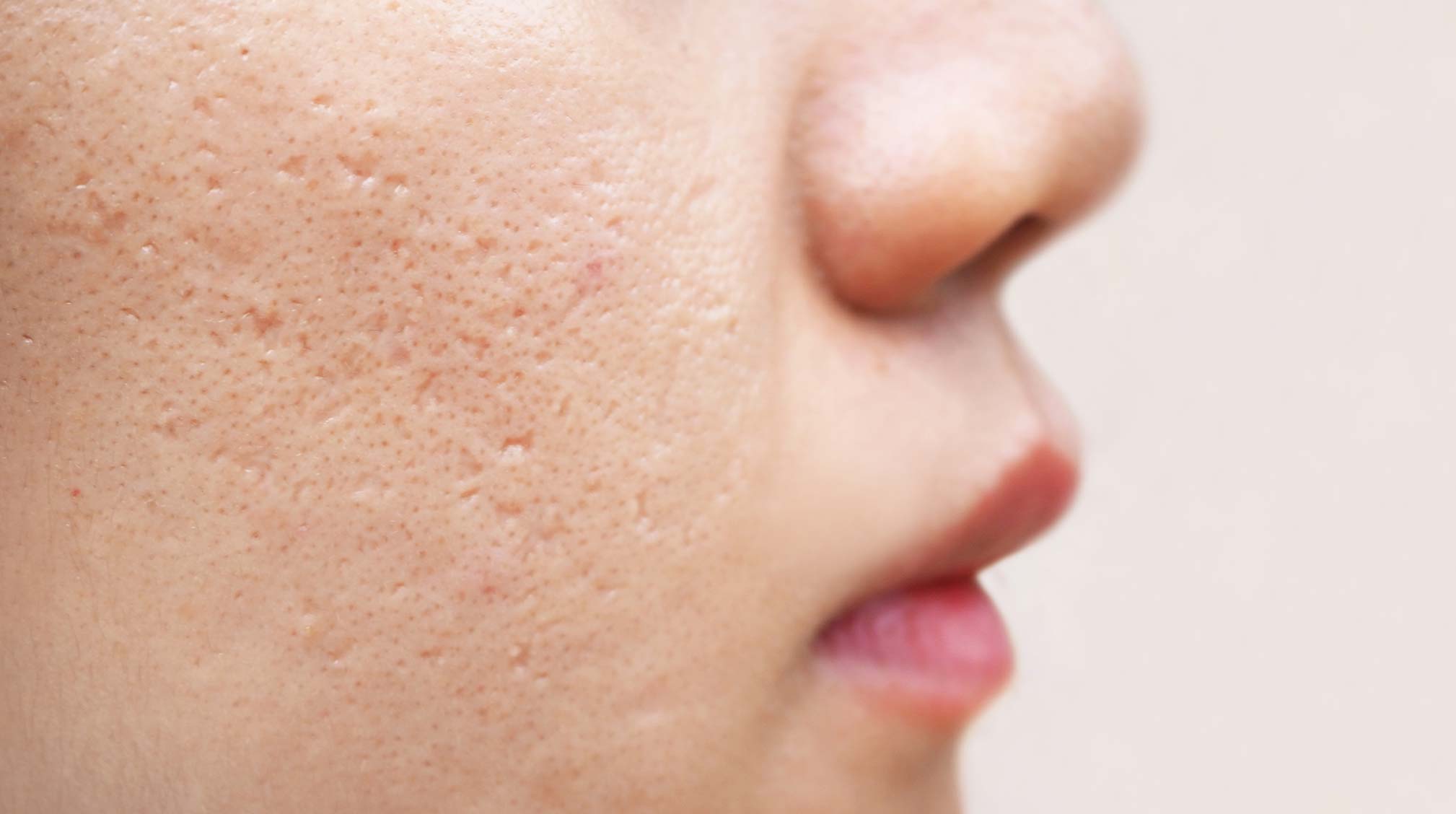 How to get rid of acne scars according to experts