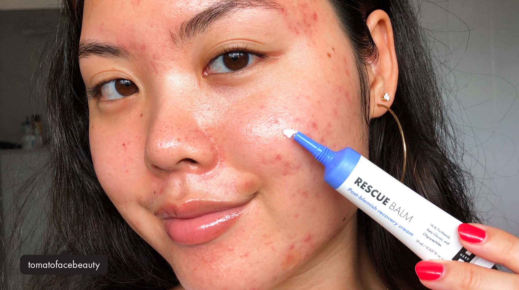 Are You Guilty of These 5 Acne Sins?