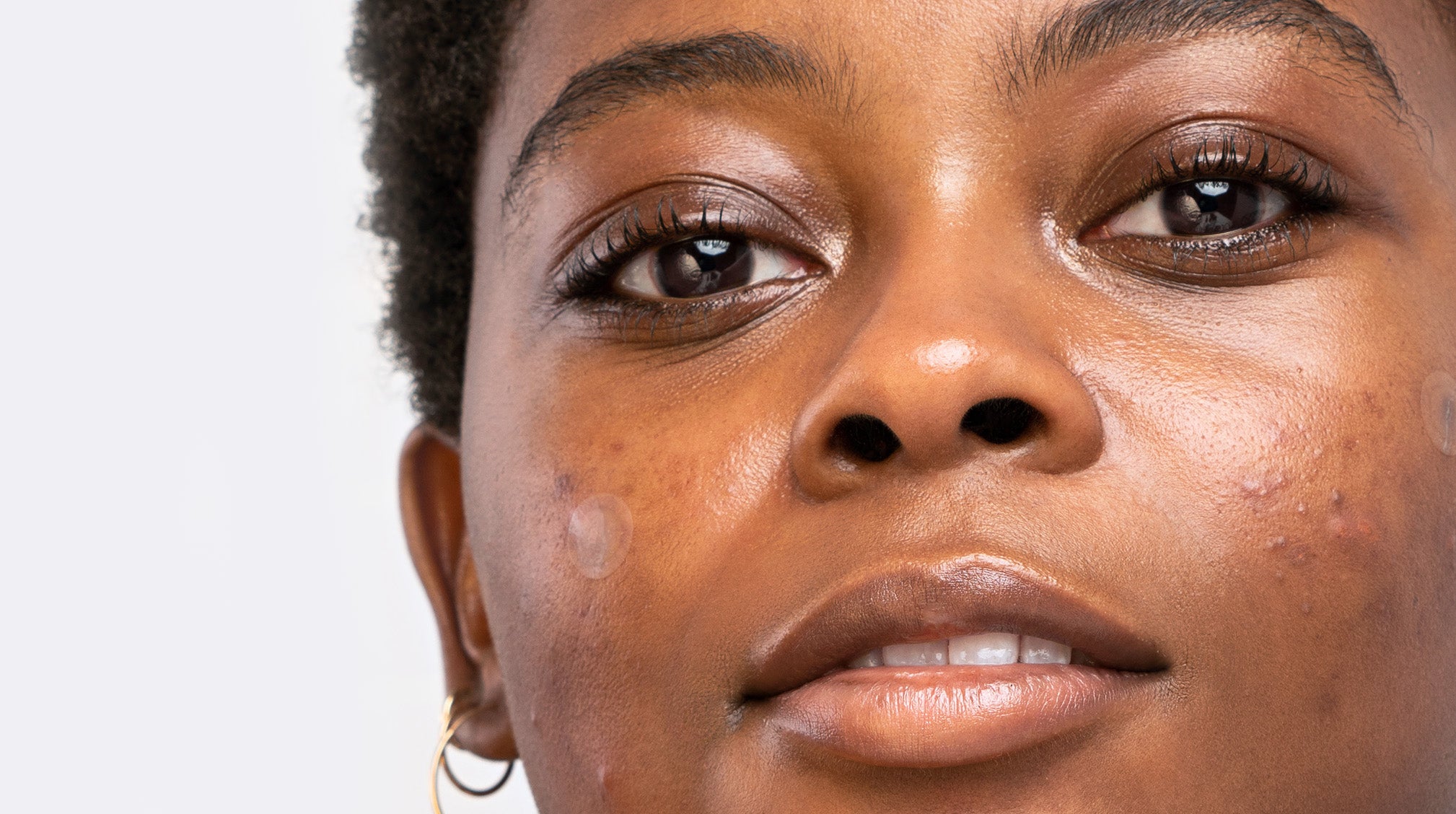 Some Pimples Are Worse Than Others: How to Treat Cystic Acne