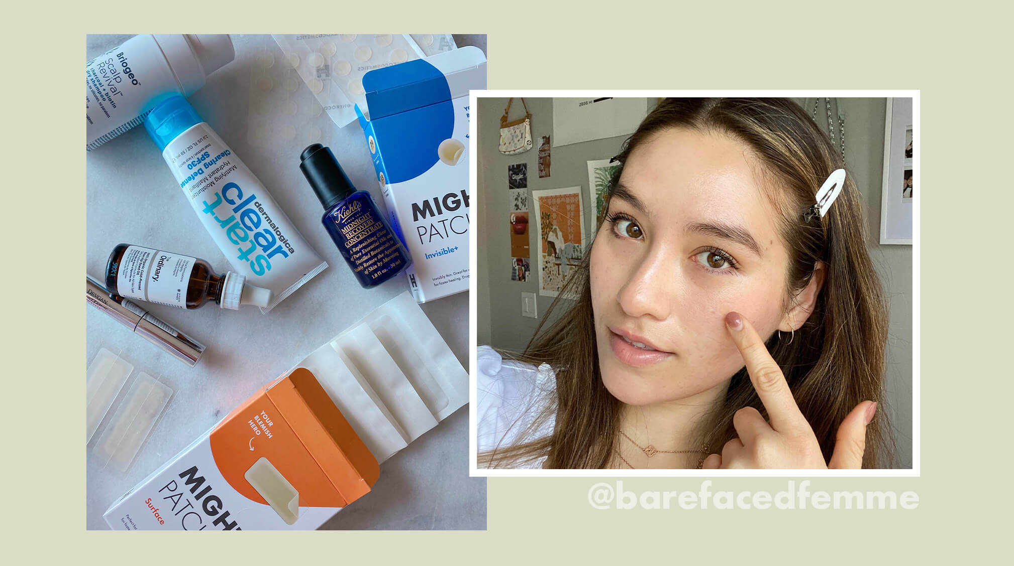 Learning to Love Our Skin With Acne Advocate Christina