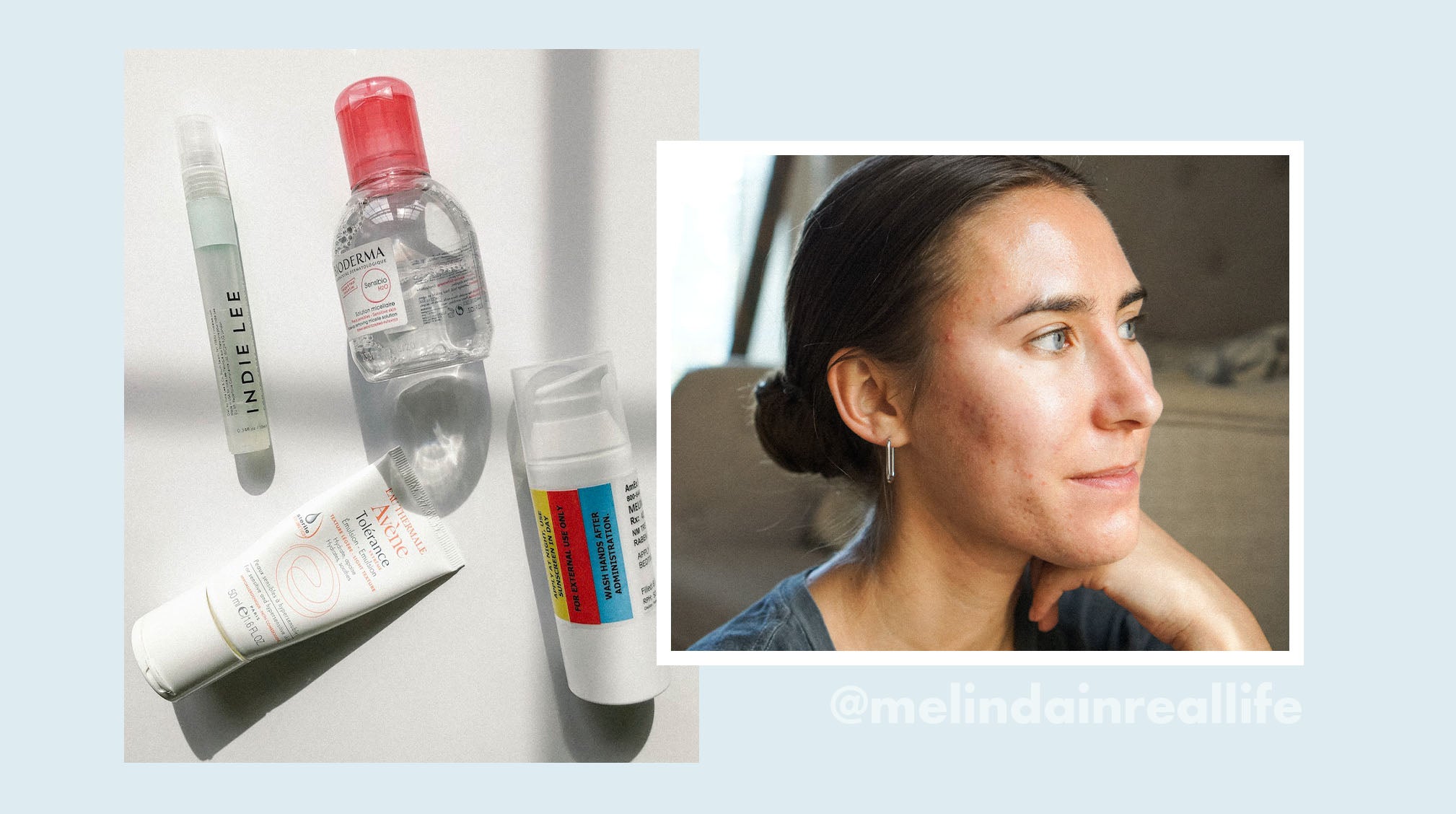 Acne Influencer Melinda Renzoni Shares the Ups and Downs of Her Acne Journey