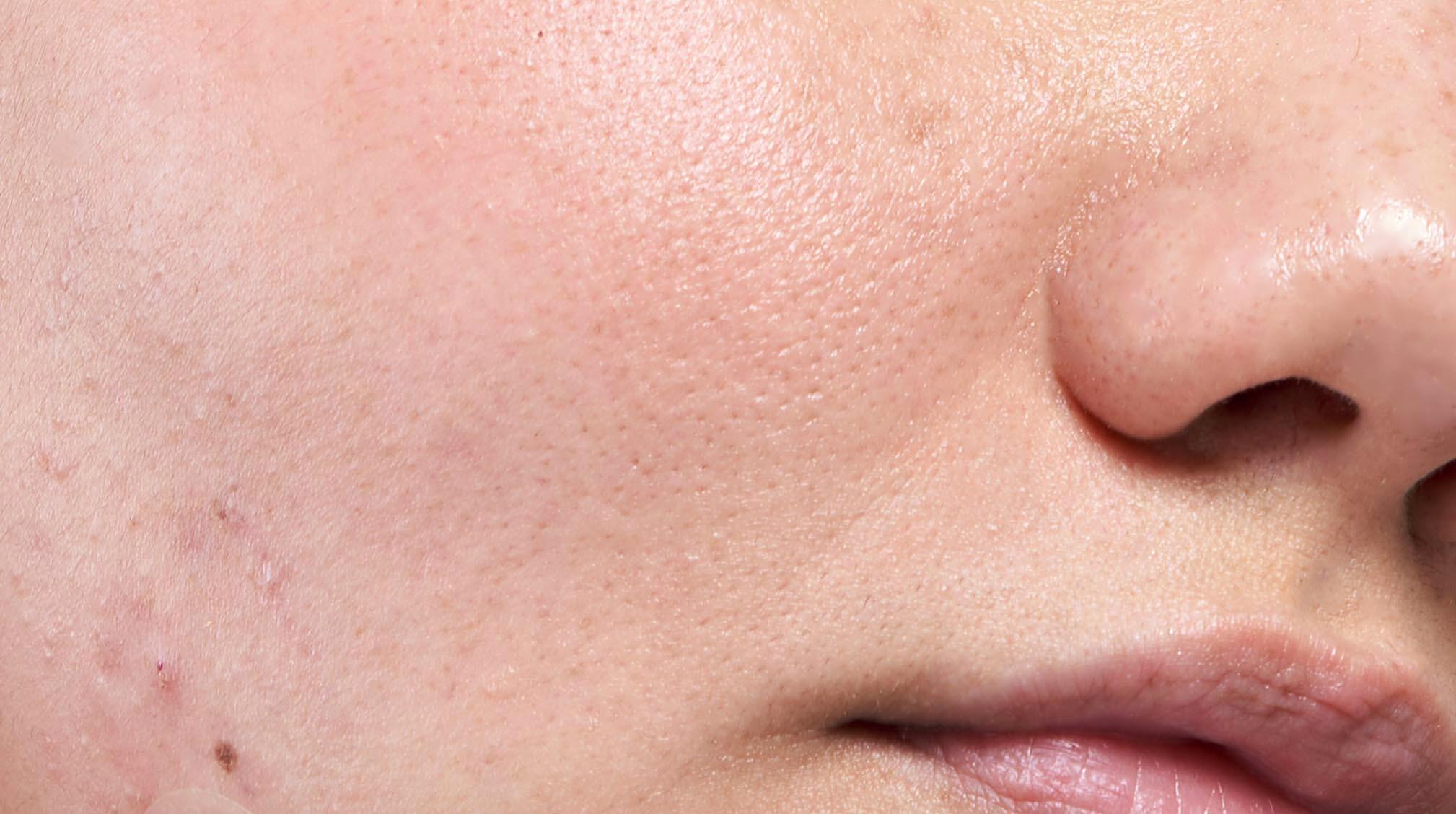 Close up of oily skin and pores
