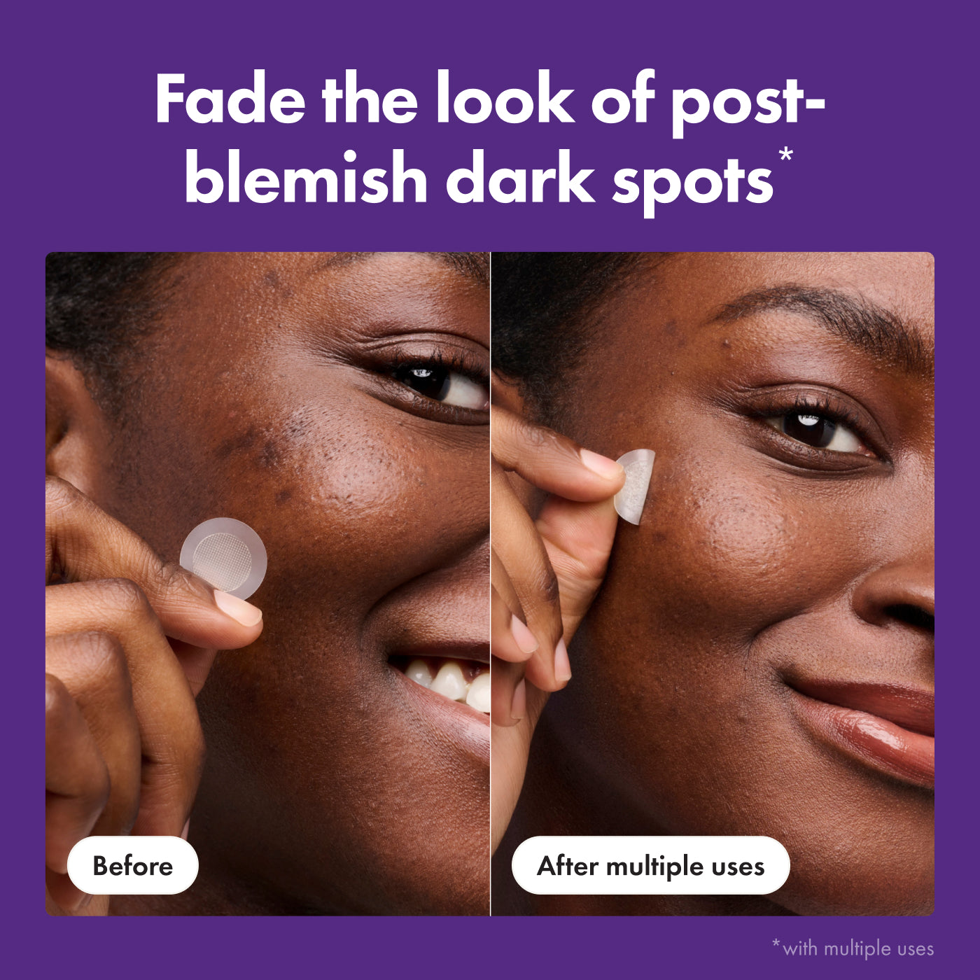 Mighty Patch™ for Dark Spots | Hero Cosmetics