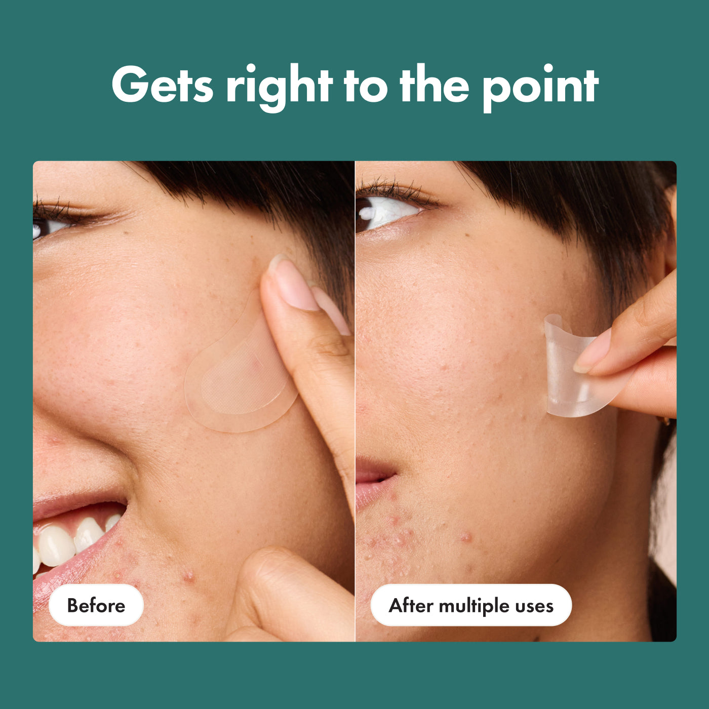 Mighty Patch™ for XL Early-Stage Blemishes | Hero Cosmetics
