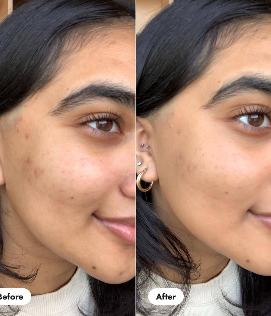 Before and after side by side of Rescue Balm +Dark Spot Retouch on a medium skin user