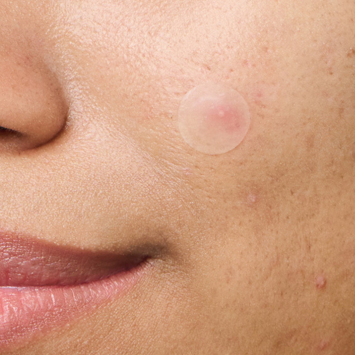 Close-up of a person's face with a Mighty Patch™ Invisible+ patch on their cheek.
