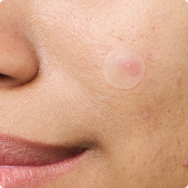 Close-up of a person's face with a Mighty Patch™ Invisible+ patch on their cheek.