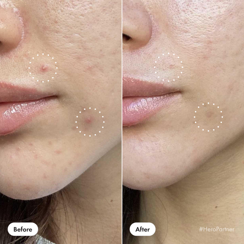 Handles even the peskiest pimples