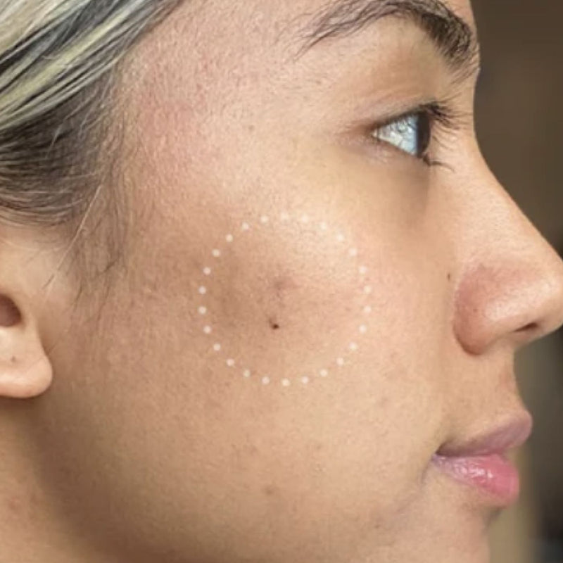 Mighty Patch Micropoint™ Microneedle Patches for Dark Spots | Hero