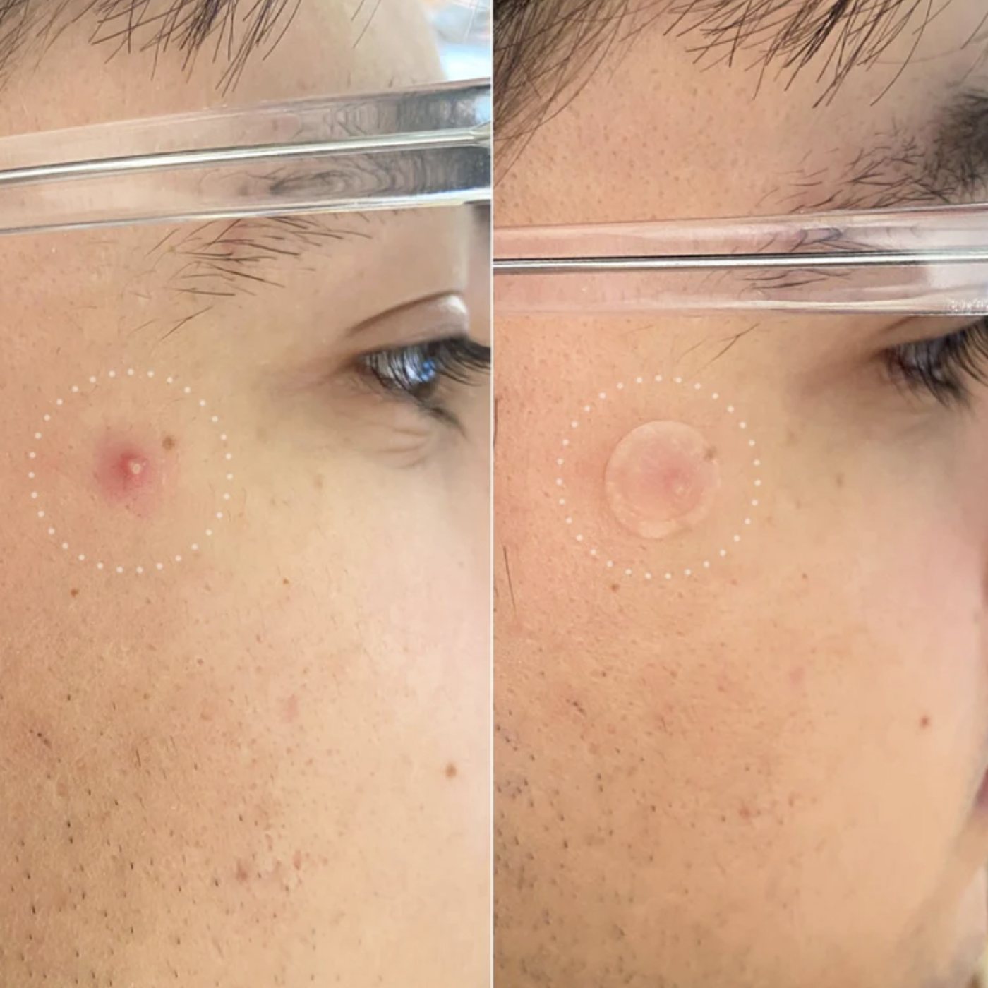 Mighty Patch Invisible + Pimple Patches