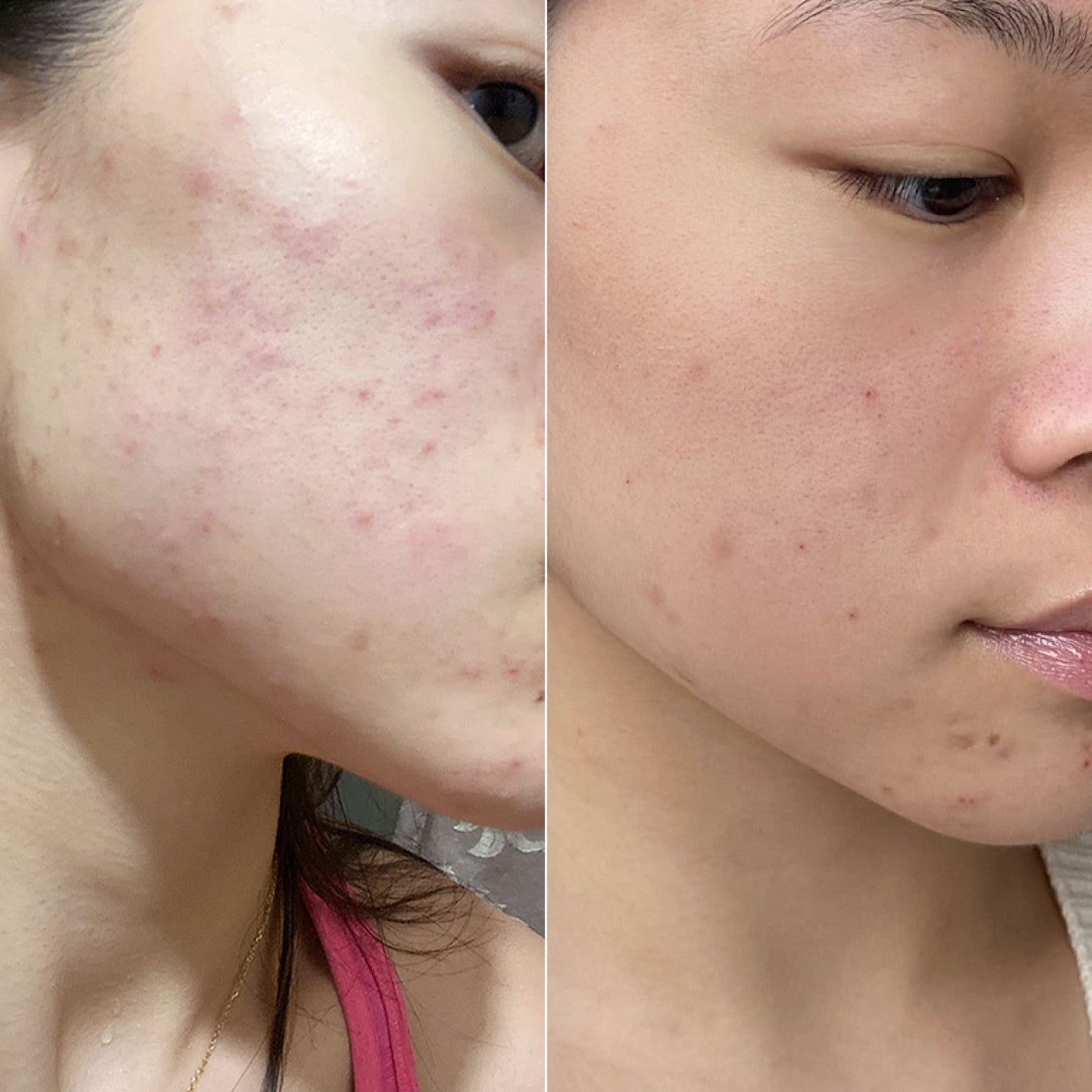 Exfoliating Jelly Cleanser Daily Face Wash for Acne-Prone Skin