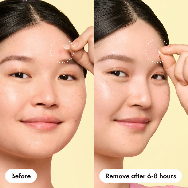So, you woke up with a surprise pimple